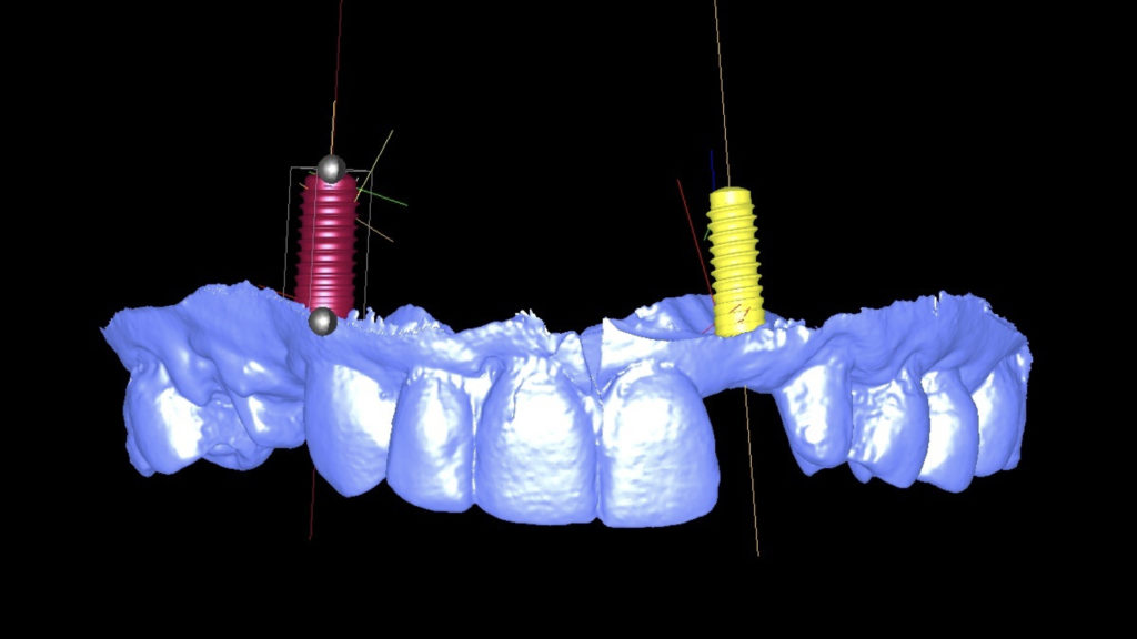 Implantes Dentales Chamberí
