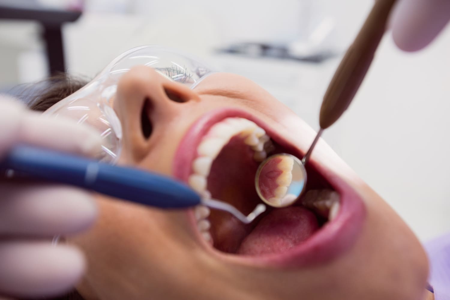 caracteristicas de la caries dental