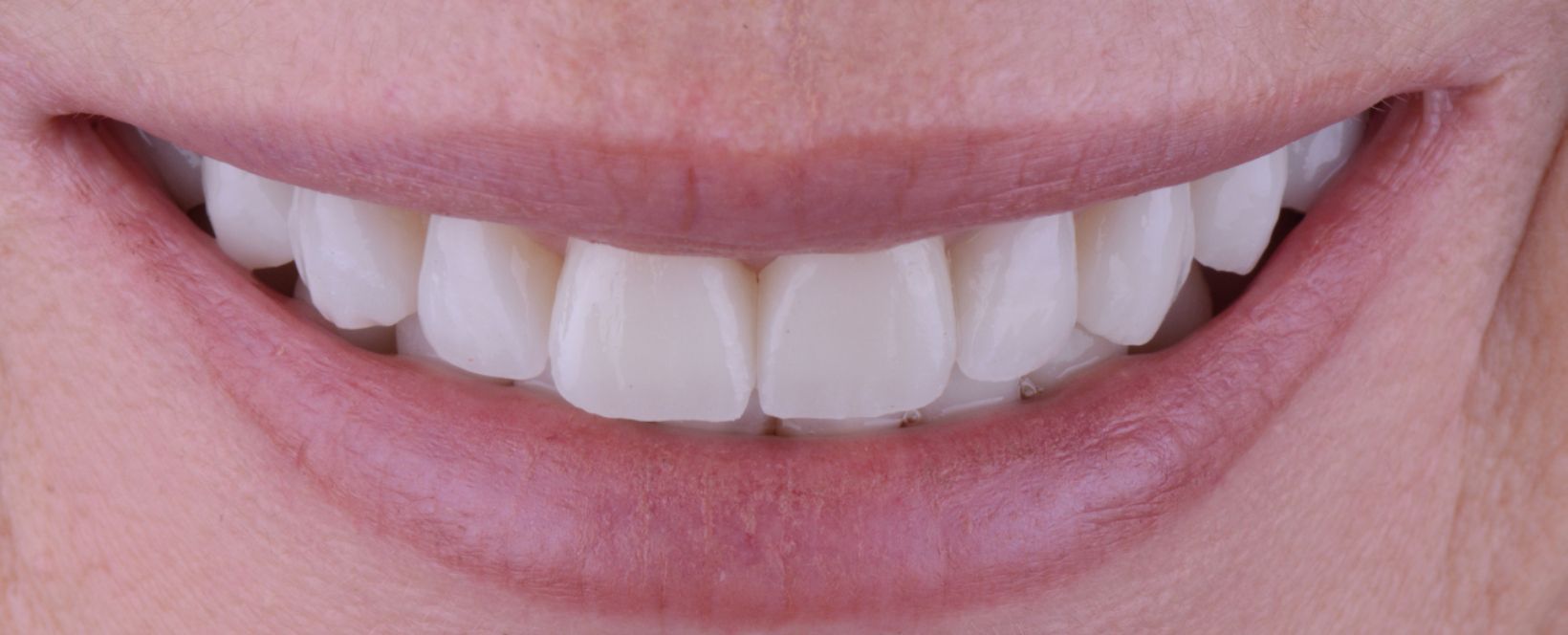 carillas dentales sin tallado