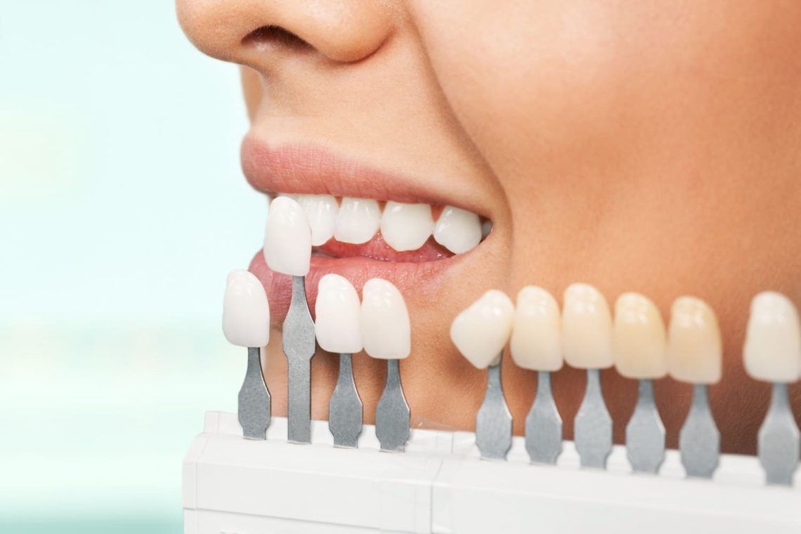 carillas dentales