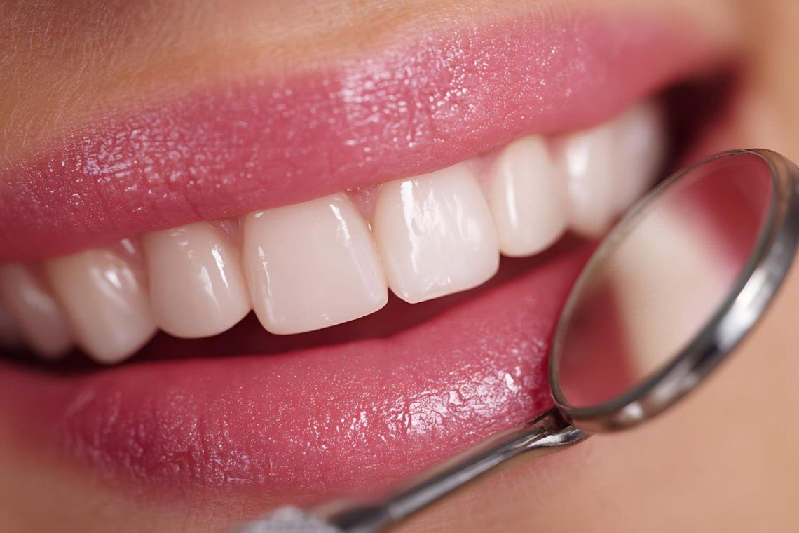 se pueden poner carillas si faltan dientes