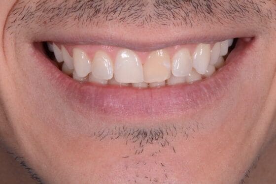 blanqueamiento dental chamberí