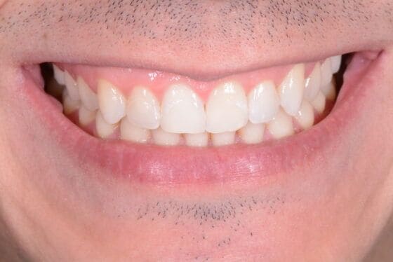 blanqueamiento dental chamberí