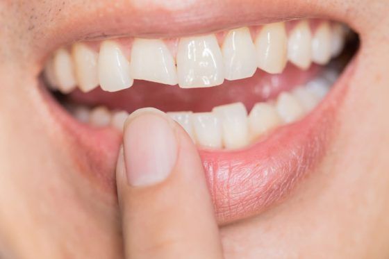 Qué es una reconstrucción dental