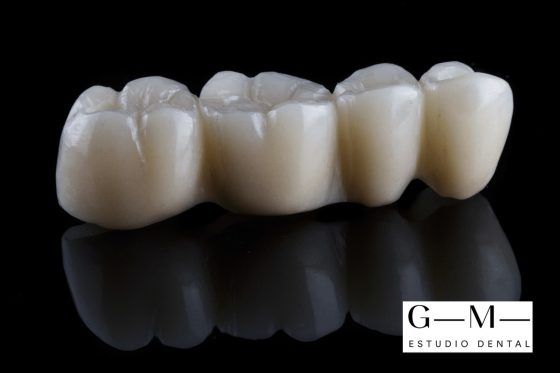 Puentes dentales
