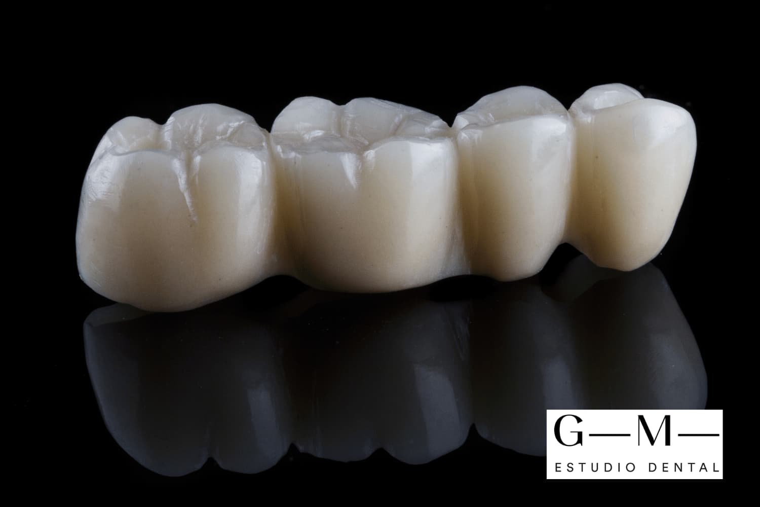 Puentes dentales